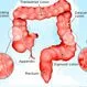 Colon Cancer (Colorectal Cancer)