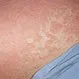Picture of Erythrodermic Psoriasis
