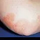 Picture of Psoriasis Vulgaris Erythematous