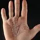 Picture of Psoriasis Vulgaris Palms