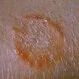 Ringworm: Treatment, Pictures, Causes, and Symptoms