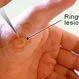 Picture of Types of Ringworm