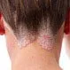 Scalp Psoriasis